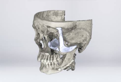 CT image of the zygomatic and orbital bone implant after surgery (Source: CSIR-CS