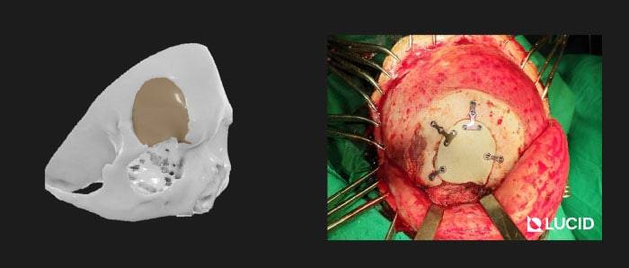 PEEK casestudy Frontal Bone Implant