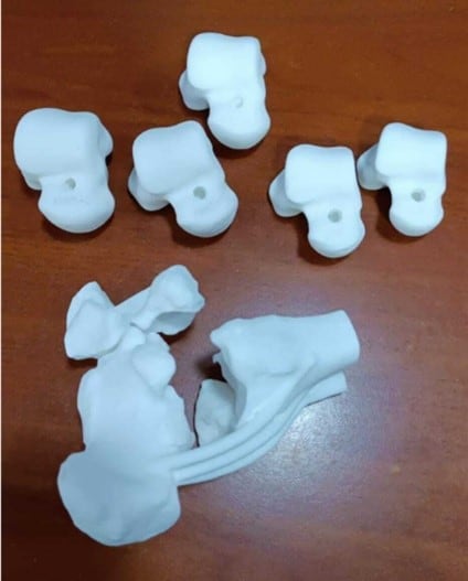 3D printed patient specific Talus spacer that aid in healing a 47-year-old man