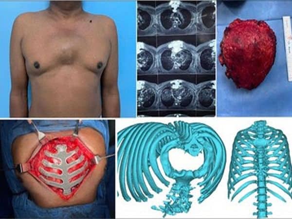 3D printing technology used for complex cancer surgery
