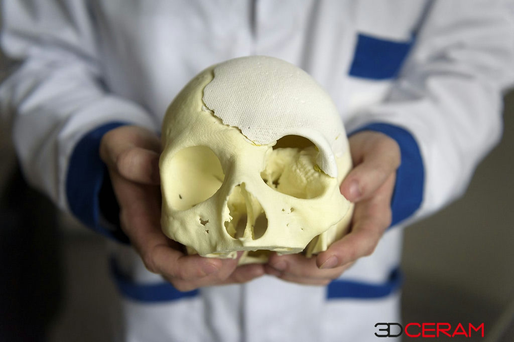 Biomedical 3DCeram Skull implant