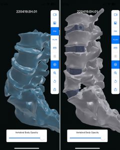 The surgical plan with 3D renderings 02
