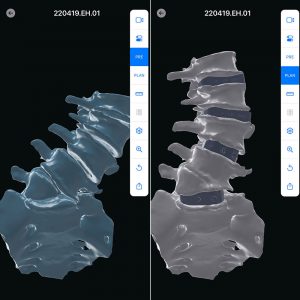 The surgical plan with 3D renderings