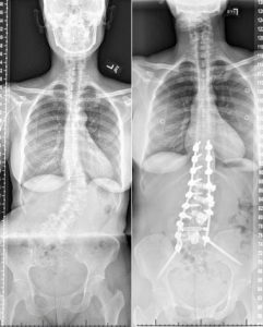 X rays of Edurne Heredias Spine