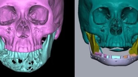 3D Printed Implant