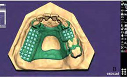 3D Printing in Dentistry 03