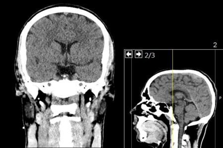 Revolutionizing Atherosclerosis Research with 3D-Bioprinted Brain Vessels