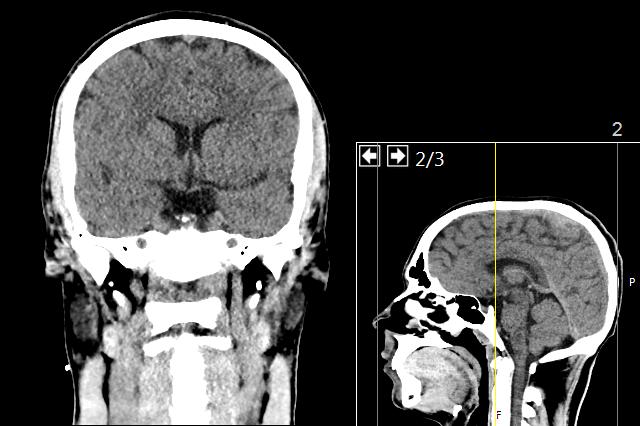 Revolutionizing Atherosclerosis Research with 3D-Bioprinted Brain Vessels